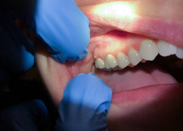 Best Emergency Dental Extractions in Morristown, IN