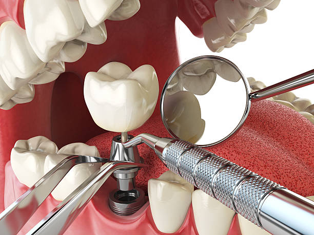 Best Emergency Dentist for Knocked-Out Tooth in Morristown, IN